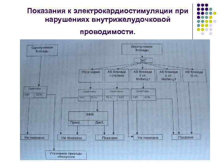 Показания к электрокардиостимуляции при нарушениях внутрижелудочковой проводимости. 
