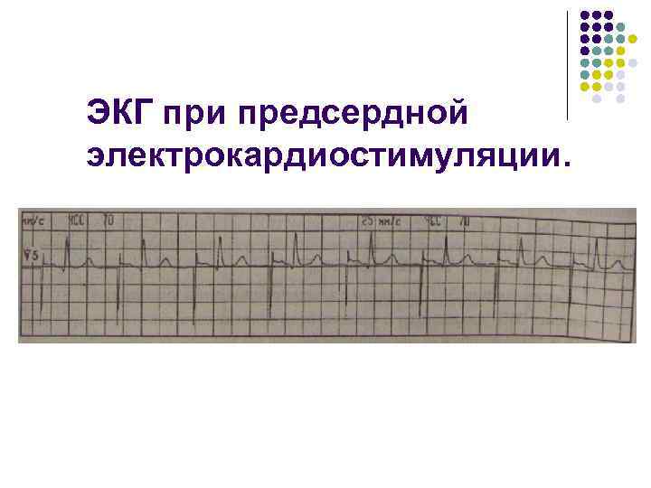 ЭКГ при предсердной электрокардиостимуляции. 