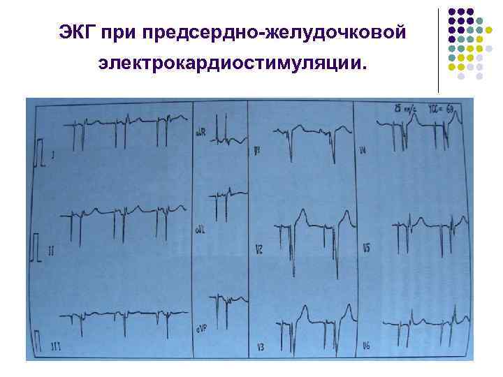 ЭКГ при предсердно-желудочковой электрокардиостимуляции. 