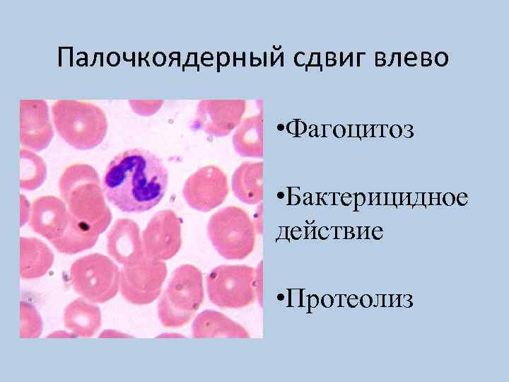 Палочкоядерные 4. Палочкоядерный сдвиг. Палочкоядерный сдвиг влево. Фагоцитоз при туберкулезе. Незавершенный фагоцитоз при туберкулезе.