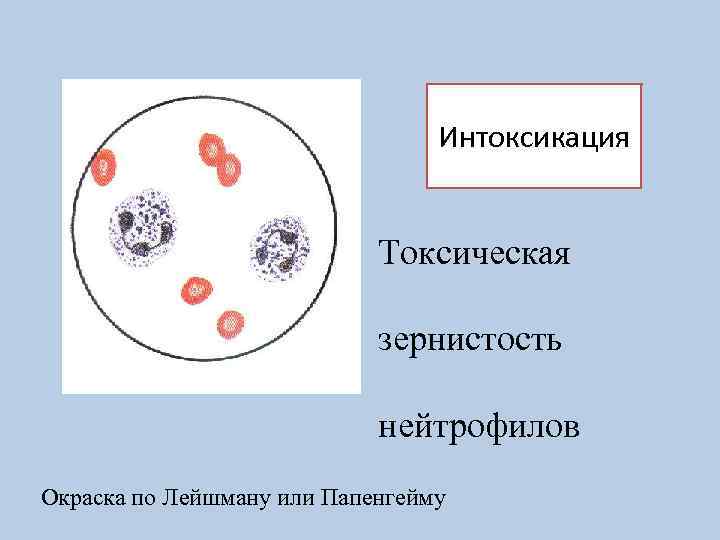 Интоксикация Токсическая зернистость нейтрофилов Окраска по Лейшману или Папенгейму 