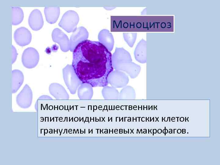 Моноцитоз Моноцит – предшественник эпителиоидных и гигантских клеток гранулемы и тканевых макрофагов. 