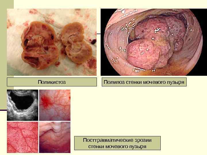 Поликистоз Полипоз стенки мочевого пузыря Посттравматические эрозии стенки мочевого пузыря 