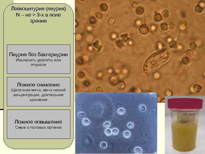 Лейкоцитурия (пиурия) N – не > 3 -х в поле зрения Пиурия без бактериурии