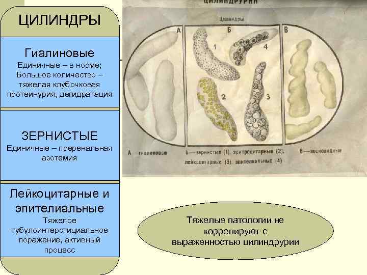 ЦИЛИНДРЫ Гиалиновые Единичные – в норме; Большое количество – тяжелая клубочковая протеинурия, дегидратация ЗЕРНИСТЫЕ