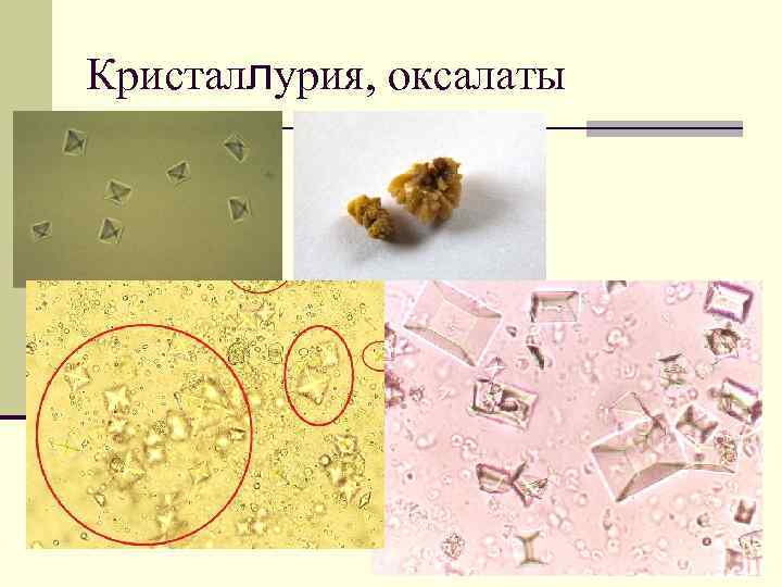 Кристаллурия, оксалаты 