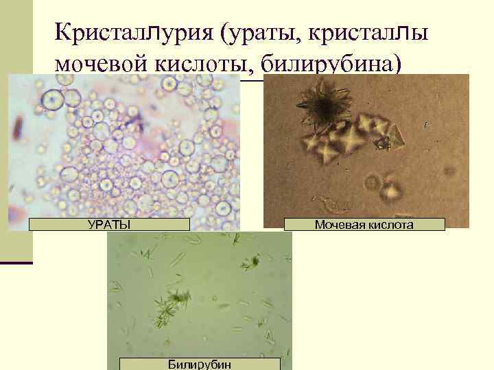 Кристаллурия (ураты, кристаллы мочевой кислоты, билирубина) УРАТЫ Мочевая кислота Билирубин 