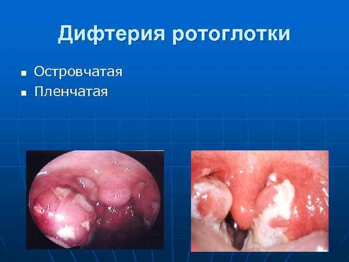 Дифтерия ротоглотки n n Островчатая Пленчатая 