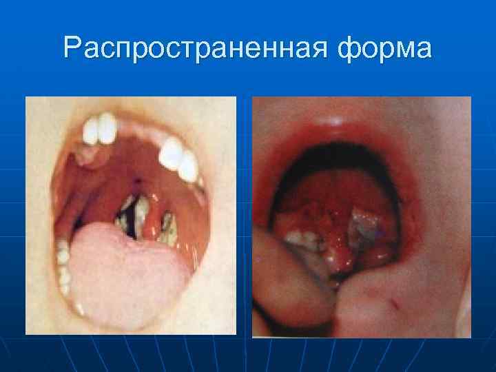 Распространенная форма 