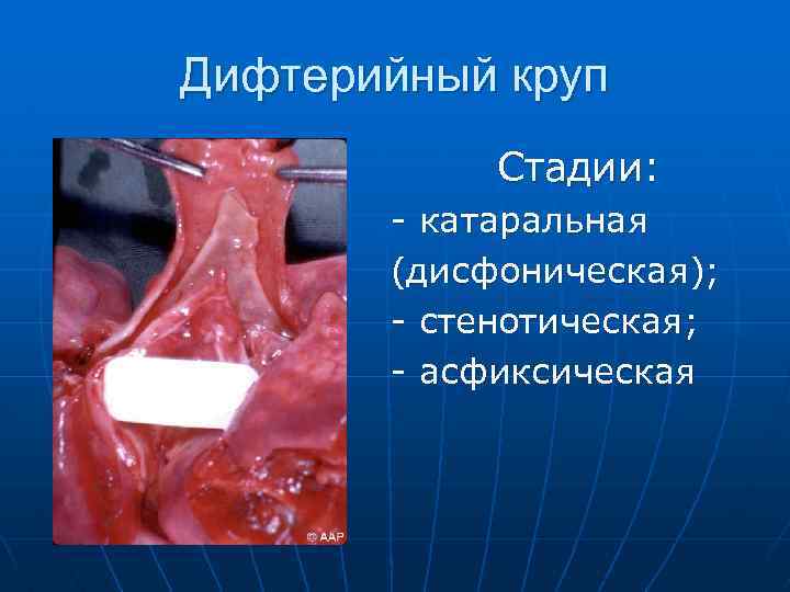 Дифтерийный круп Стадии: - катаральная (дисфоническая); - стенотическая; - асфиксическая 
