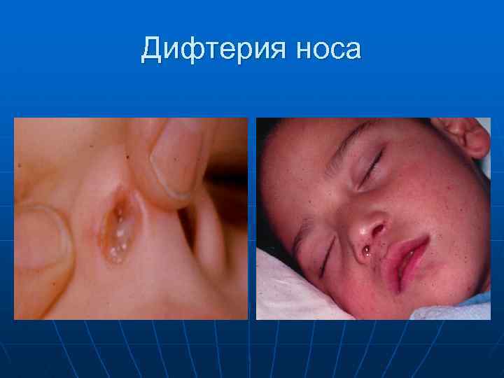 Дифтерия носа 