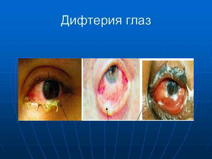 Дифтерия глаз 