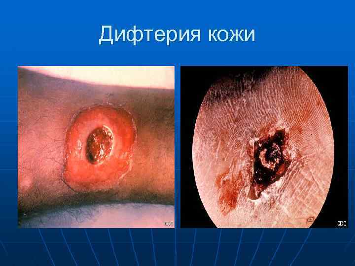 Дифтерия кожи 