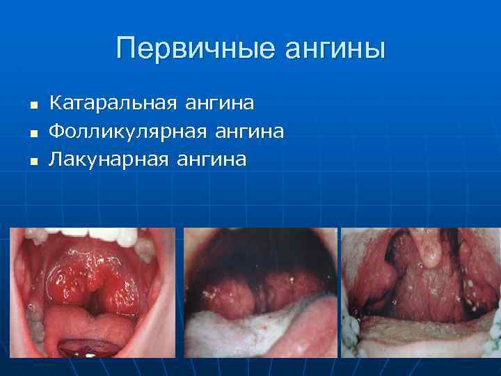 Первичные ангины n n n Катаральная ангина Фолликулярная ангина Лакунарная ангина 