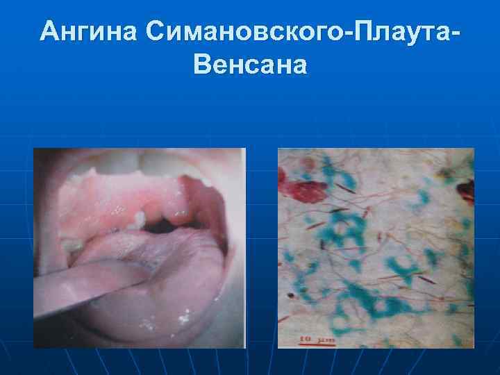 Ангина Симановского-Плаута. Венсана 