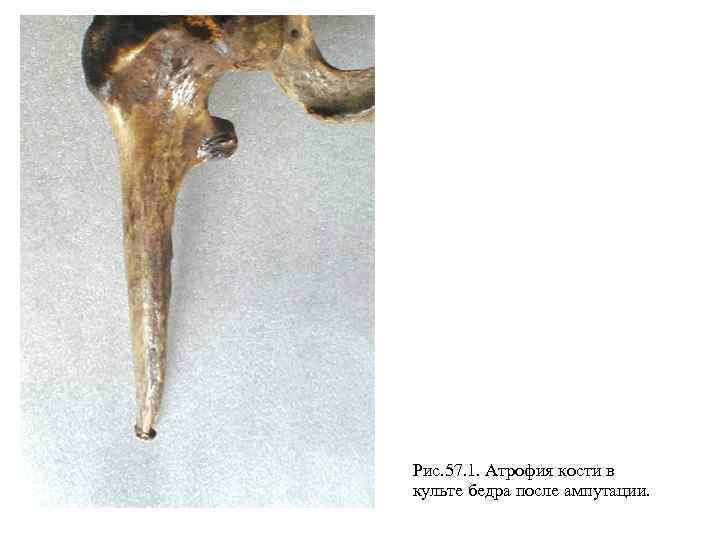 Рис. 57. 1. Атрофия кости в культе бедра после ампутации. 