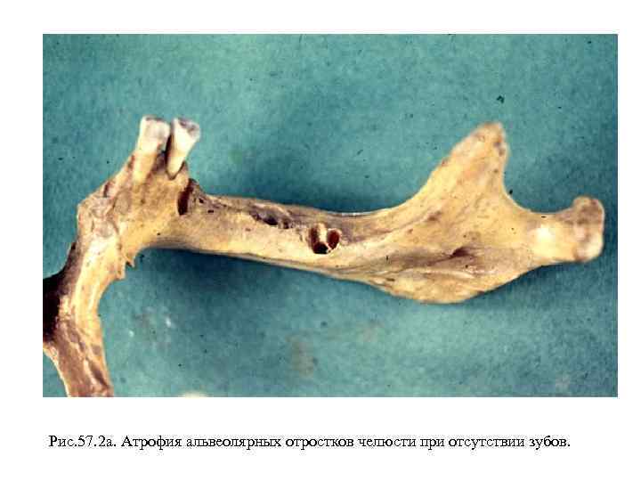 Рис. 57. 2 а. Атрофия альвеолярных отростков челюсти при отсутствии зубов. 