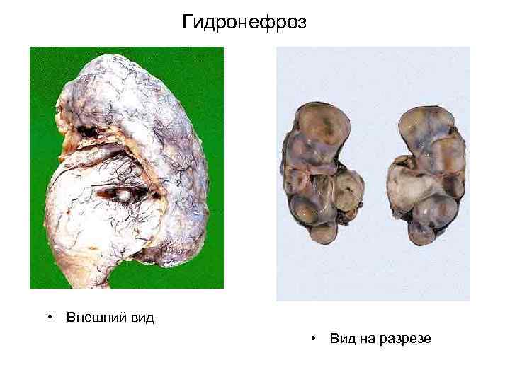 Гидронефроз • Внешний вид • Вид на разрезе 