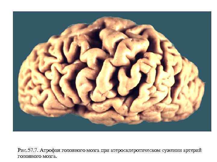 Рис. 57. 7. Атрофия головного мозга при атеросклеротическом сужении артерий головного мозга. 