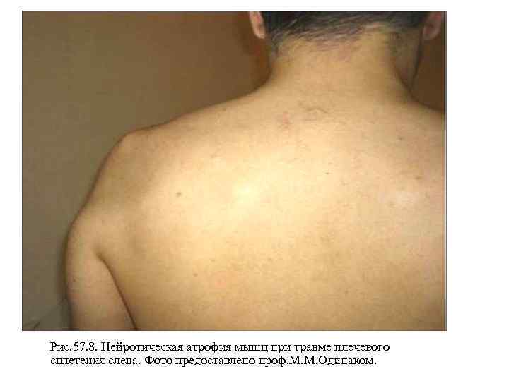 Рис. 57. 8. Нейротическая атрофия мышц при травме плечевого сплетения слева. Фото предоставлено проф.