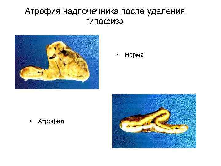 Атрофия надпочечника после удаления гипофиза • Норма • Атрофия 