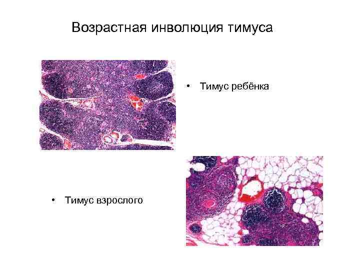 Инволюция железы. Акцидентальная инволюция тимуса препарат. Возрастная инволюция тимуса микропрепарат. Акцидентальная инволюция тимуса 2 фаза. Возрастная и акцидентальная инволюция тимуса гистология.