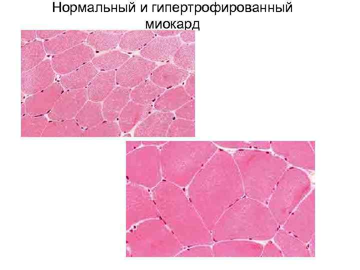 Нормальный и гипертрофированный миокард 