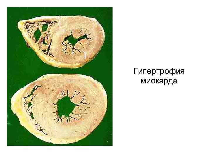 Гипертрофия миокарда рисунок