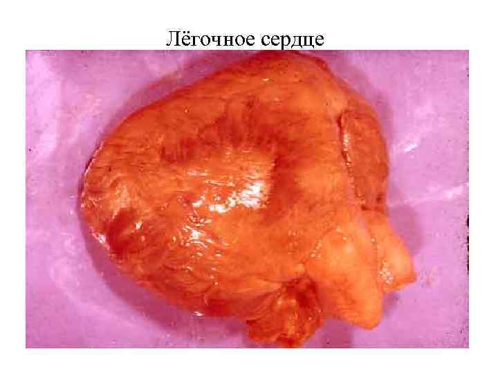 Лёгочное сердце 