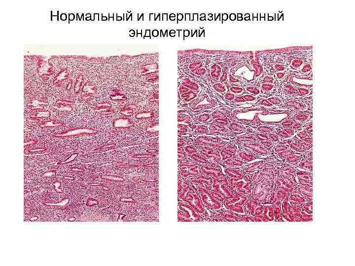 Выраженный сосудистый рисунок эндометрия