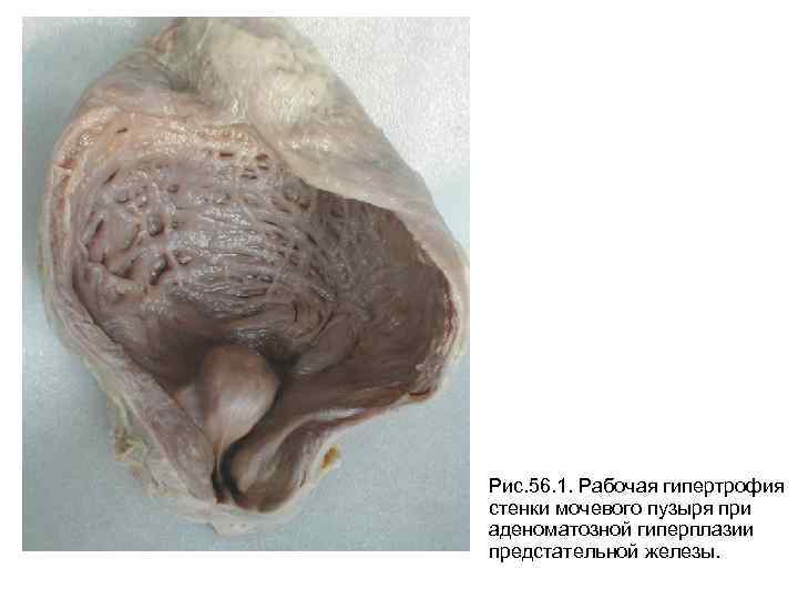 Рис. 56. 1. Рабочая гипертрофия стенки мочевого пузыря при аденоматозной гиперплазии предстательной железы. 