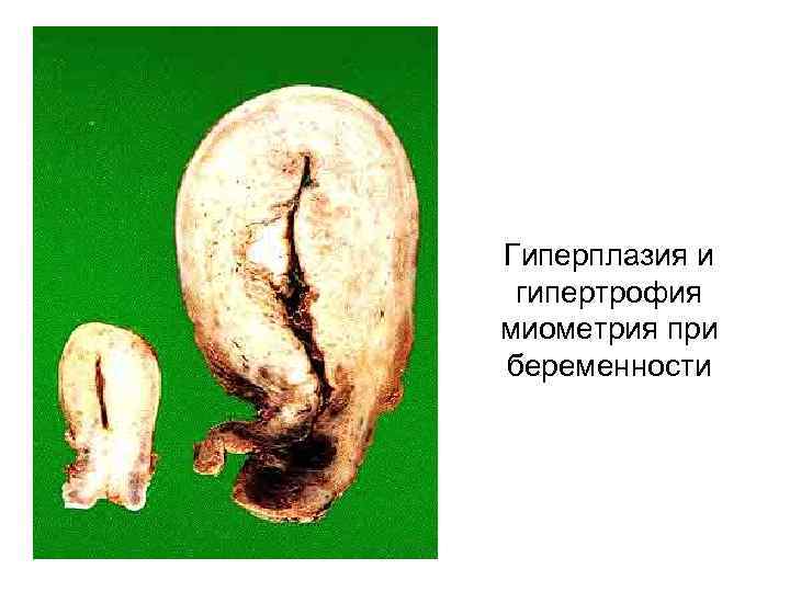 Гиперплазия и гипертрофия миометрия при беременности 