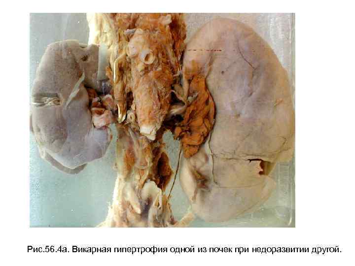 Рис. 56. 4 а. Викарная гипертрофия одной из почек при недоразвитии другой. 