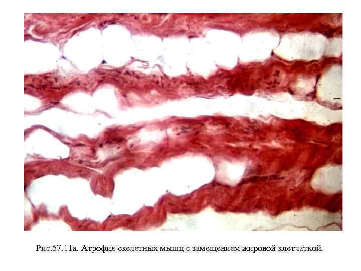 Рис. 57. 11 а. Атрофия скелетных мышц с замещением жировой клетчаткой. 