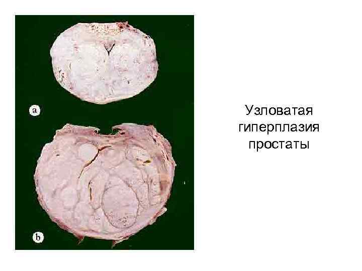Узловатая гиперплазия простаты 