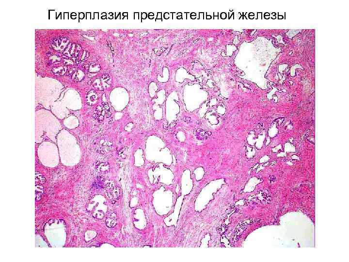 Гиперплазия предстательной железы 