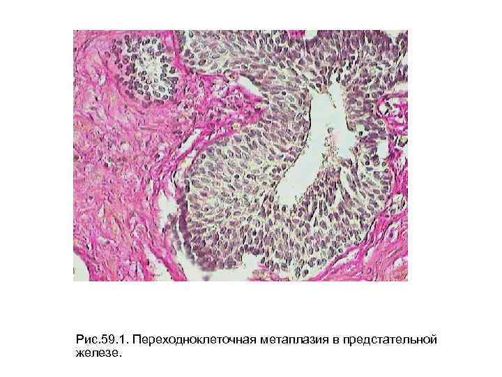 Плоскоклеточная эндометрия. Аденокарцинома предстательной железы гистология. Плоскоклеточная метаплазия эндометрия гистология. Переходно клеточная метаплазия предстательной железы. Уротелиальная карцинома гистология.