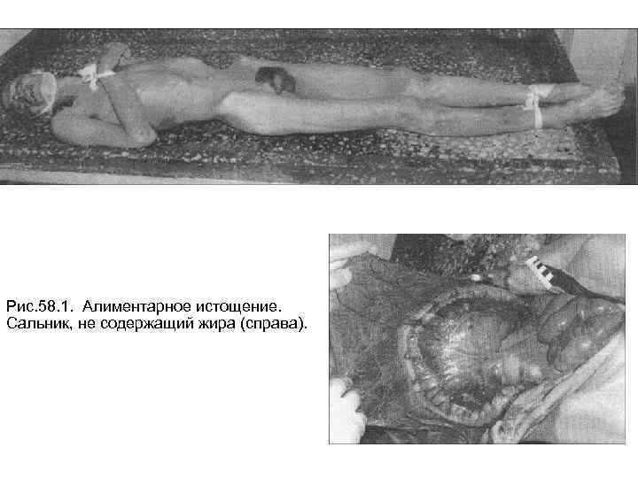 Рис. 58. 1. Алиментарное истощение. Сальник, не содержащий жира (справа). 