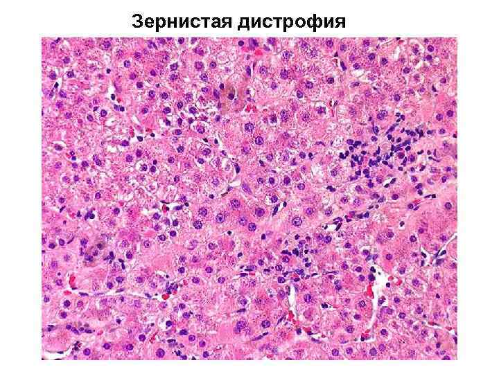 Зернистая дистрофия 