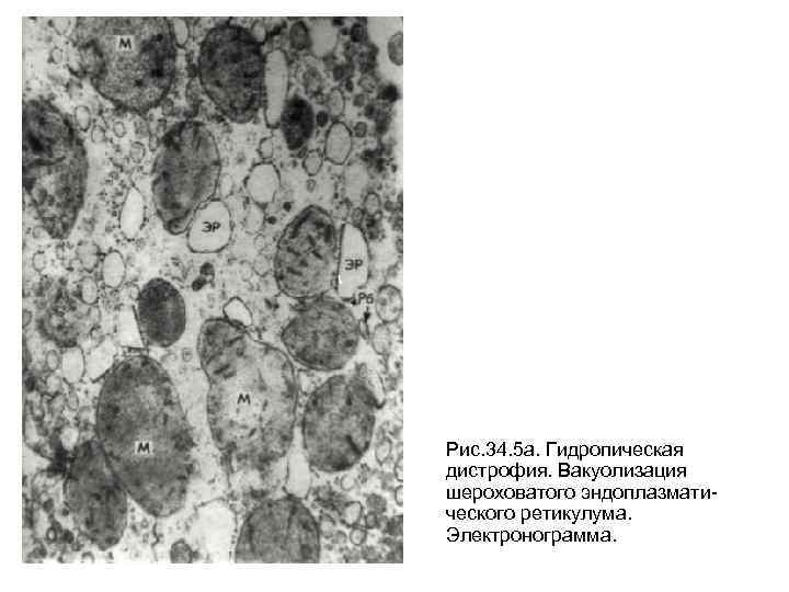 Рис. 34. 5 а. Гидропическая дистрофия. Вакуолизация шероховатого эндоплазматического ретикулума. Электронограмма. 