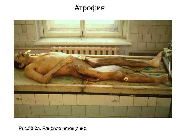 Атрофия Рис. 58. 2 а. Раневое истощение. 