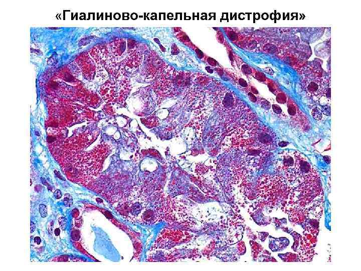  «Гиалиново-капельная дистрофия» 