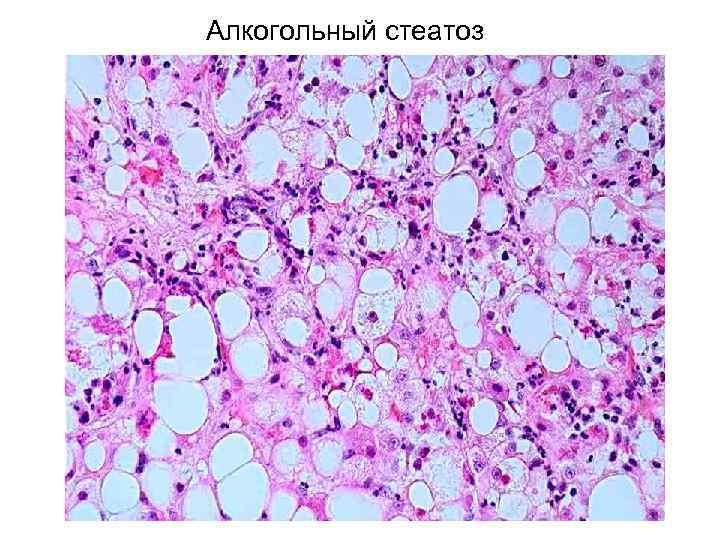 Алкогольный стеатоз 