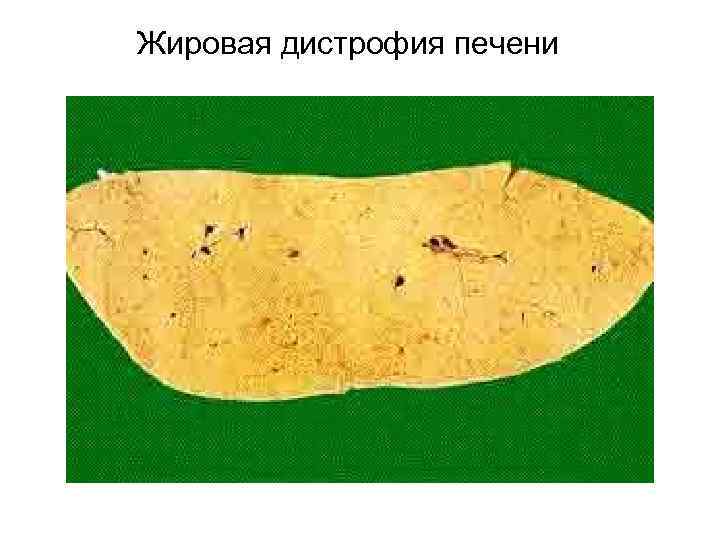 Жировая дистрофия печени 
