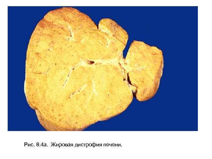 Рис. 8. 4 а. Жировая дистрофия печени. 