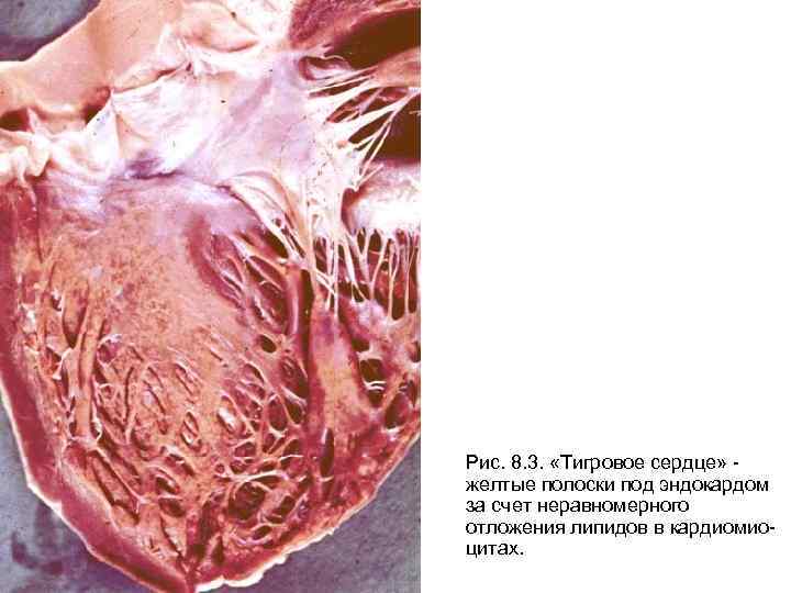 Рис. 8. 3. «Тигровое сердце» желтые полоски под эндокардом за счет неравномерного отложения липидов