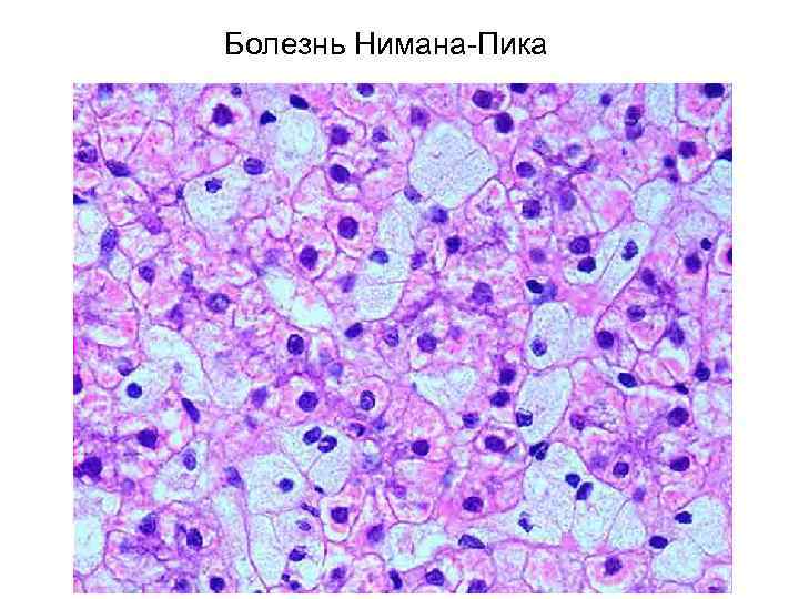 Болезнь Нимана-Пика 