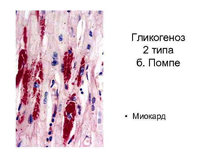 Гликогеноз 2 типа б. Помпе • Миокард 