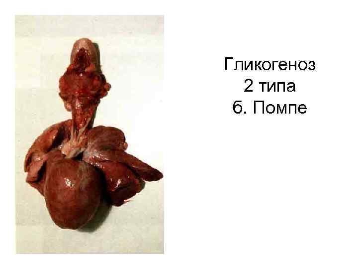 Гликогеноз 2 типа б. Помпе 