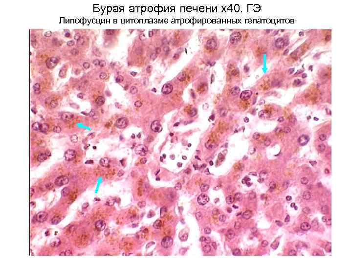 Бурая атрофия печени х40. ГЭ Липофусцин в цитоплазме атрофированных гепатоцитов 